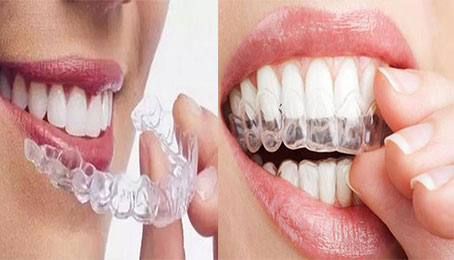 牙科奇闻----牙签是如何发明的     隐形矫正知识